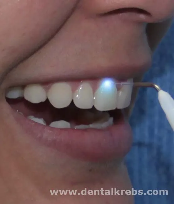 Tratamiento de desensibilización dental con láser diodo